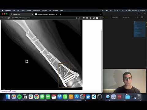 Revolutionizing Radiology: RontgenAI&#039;s Fracture Detection Demo